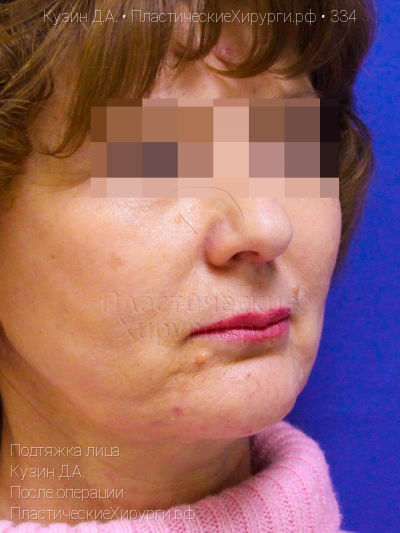 подтяжка лица, пластический хирург Кузин Д. А., результат №334, ракурс 2, фото после операции