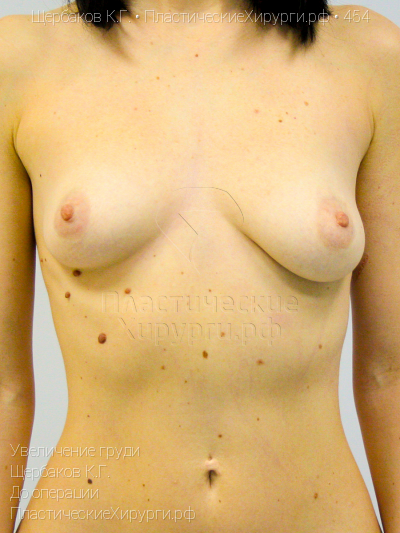 увеличение груди, пластический хирург Щербаков К. Г., результат №454, ракурс 1, фото до операции