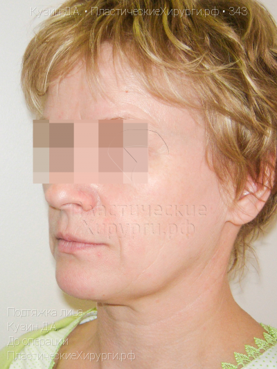 подтяжка лица, пластический хирург Кузин Д. А., результат №343, ракурс 2, фото до операции