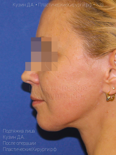 подтяжка лица, пластический хирург Кузин Д. А., результат №339, ракурс 3, фото после операции