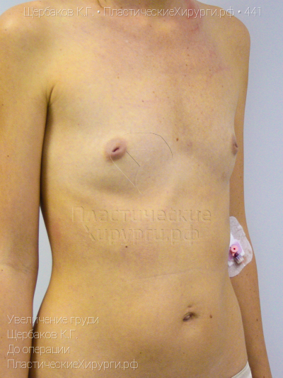 увеличение груди, пластический хирург Щербаков К. Г., результат №441, ракурс 2, фото до операции