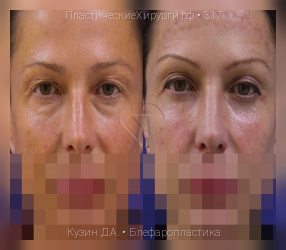 блефаропластика, результат №317, предварительное изображение до и после операции