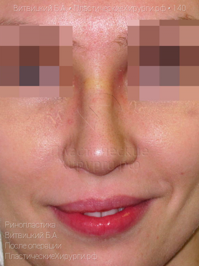 ринопластика, пластический хирург Витвицкий Б. А., результат №140, ракурс 1, фото после операции