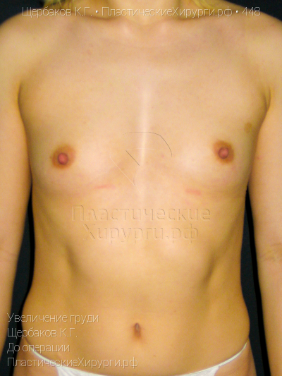 увеличение груди, пластический хирург Щербаков К. Г., результат №448, ракурс 1, фото до операции