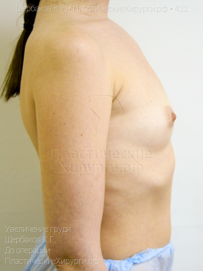 увеличение груди, пластический хирург Щербаков К. Г., результат №422, ракурс 3, фото до операции