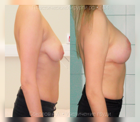 увеличение груди, результат №514, предварительное изображение до и после операции