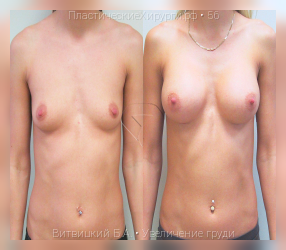 увеличение груди, результат №56, предварительное изображение до и после операции