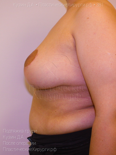 подтяжка груди, пластический хирург Кузин Д. А., результат №381, ракурс 3, фото после операции