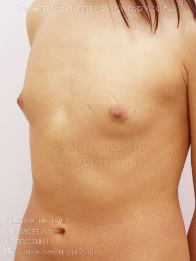 увеличение груди, пластический хирург Моураова Л. Б., результат №296, ракурс 2, фото до операции