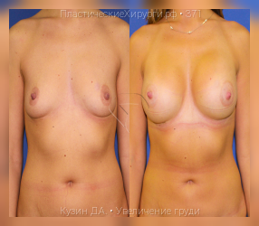 увеличение груди, результат №371, предварительное изображение до и после операции