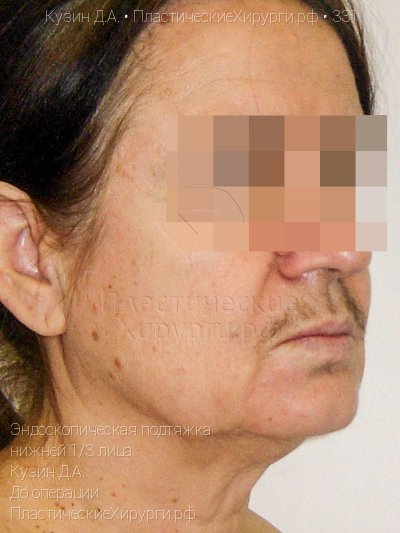 эндоскопическая подтяжка нижней трети лица, пластический хирург Кузин Д. А., результат №331, ракурс 2, фото до операции