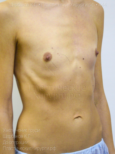 увеличение груди, пластический хирург Щербаков К. Г., результат №444, ракурс 2, фото до операции