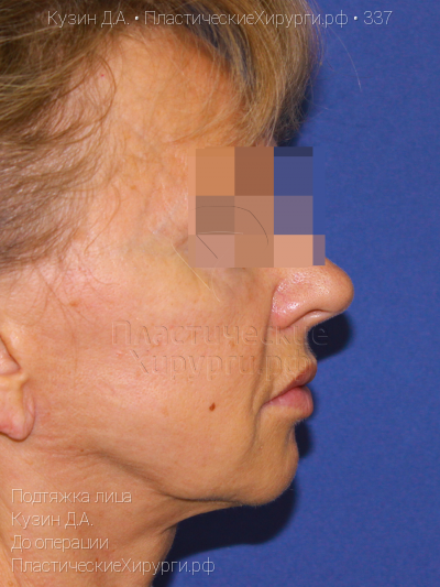 подтяжка лица, пластический хирург Кузин Д. А., результат №337, ракурс 3, фото до операции