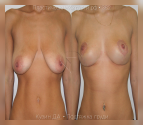 подтяжка груди, результат №382, предварительное изображение до и после операции