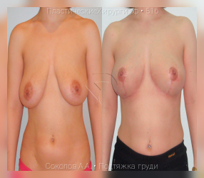 подтяжка груди, результат №516, предварительное изображение до и после операции