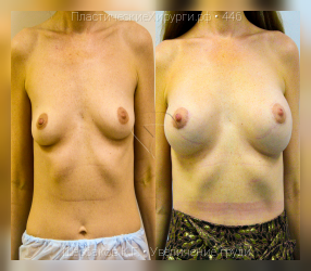 увеличение груди, результат №446, предварительное изображение до и после операции