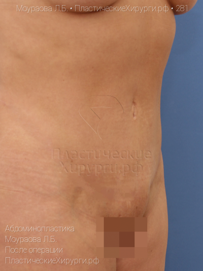 абдоминопластика, пластический хирург Моураова Л. Б., результат №281, ракурс 2, фото после операции