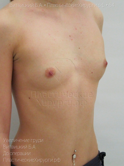 увеличение груди, пластический хирург Витвицкий Б. А., результат №64, ракурс 2, фото до операции