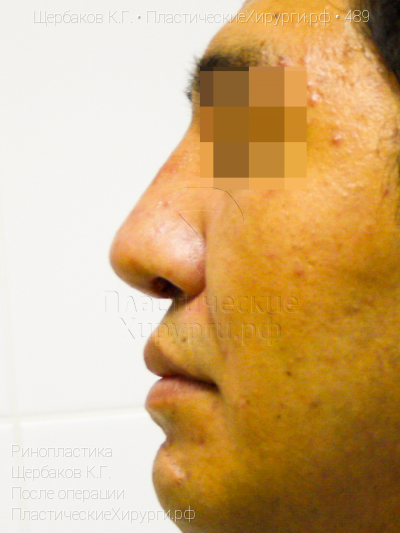 ринопластика, пластический хирург Щербаков К. Г., результат №489, ракурс 5, фото после операции