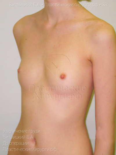 увеличение груди, пластический хирург Витвицкий Б. А., результат №38, ракурс 4, фото до операции