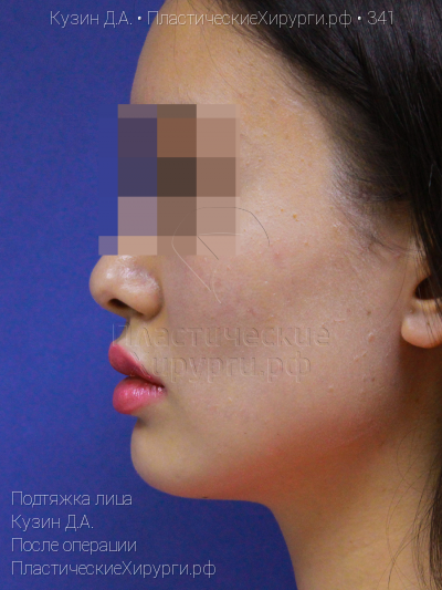 подтяжка лица, пластический хирург Кузин Д. А., результат №341, ракурс 3, фото после операции