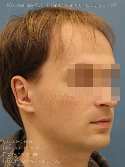 отопластика, пластический хирург Мошкалова А. Л., результат №502, ракурс 2, фото после операции