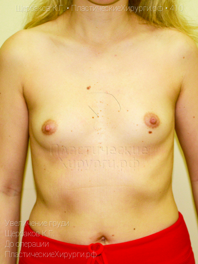 увеличение груди, пластический хирург Щербаков К. Г., результат №410, ракурс 1, фото до операции