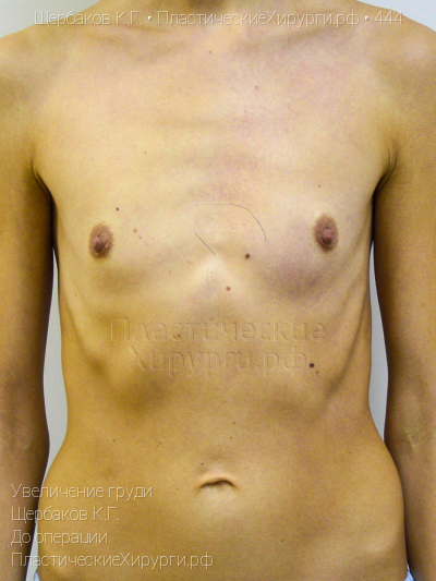 увеличение груди, пластический хирург Щербаков К. Г., результат №444, ракурс 1, фото до операции