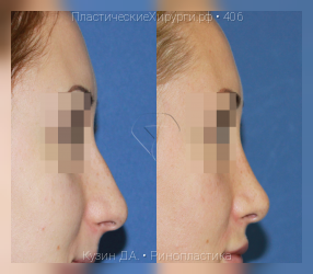 ринопластика, результат №406, предварительное изображение до и после операции