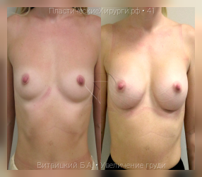 увеличение груди, результат №41, предварительное изображение до и после операции