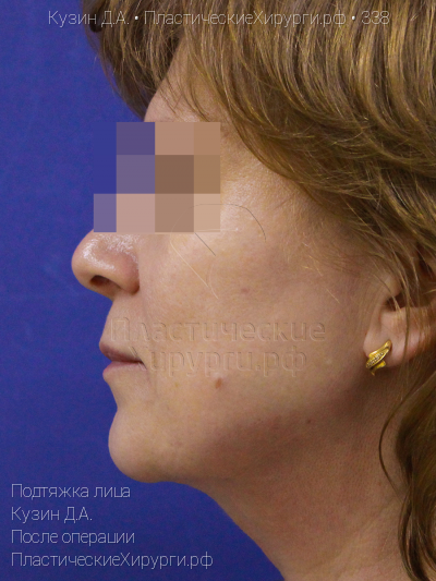 подтяжка лица, пластический хирург Кузин Д. А., результат №338, ракурс 2, фото после операции