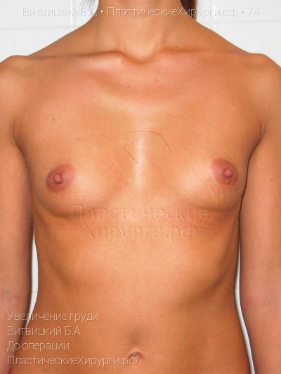 увеличение груди, пластический хирург Витвицкий Б. А., результат №74, ракурс 1, фото до операции