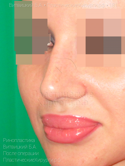 ринопластика, пластический хирург Витвицкий Б. А., результат №181, ракурс 3, фото после операции