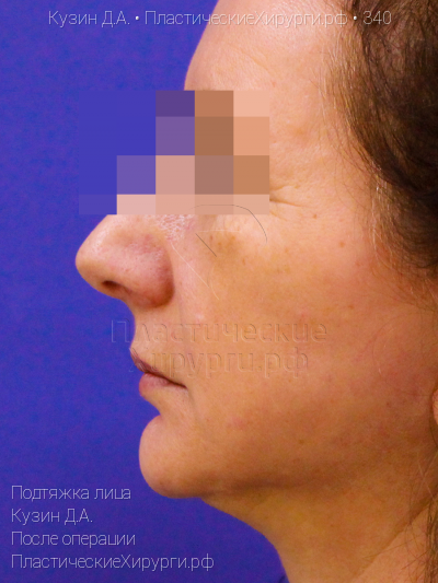подтяжка лица, пластический хирург Кузин Д. А., результат №340, ракурс 3, фото после операции