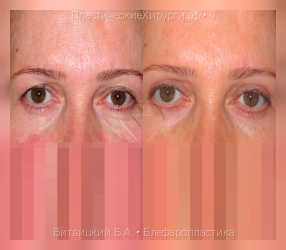 блефаропластика, результат №9, предварительное изображение до и после операции
