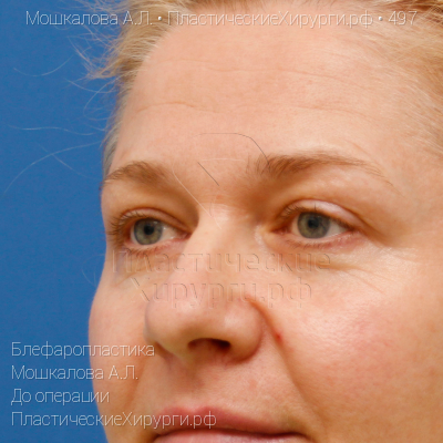 блефаропластика, пластический хирург Мошкалова А. Л., результат №497, ракурс 3, фото до операции