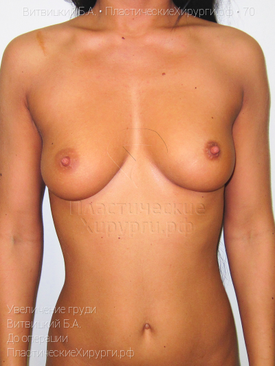 увеличение груди, пластический хирург Витвицкий Б. А., результат №70, ракурс 1, фото до операции