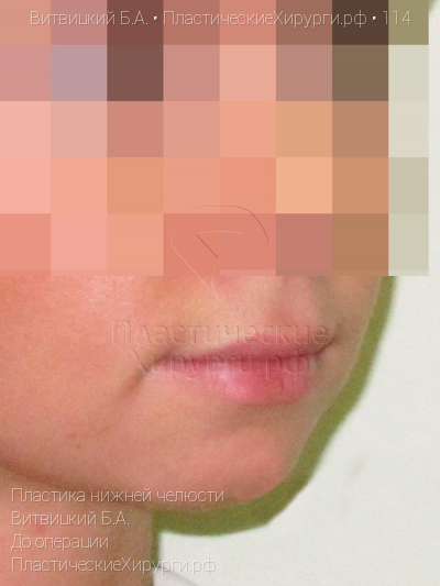 пластика нижней челюсти, пластический хирург Витвицкий Б. А., результат №114, ракурс 2, фото до операции