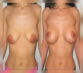 увеличение груди, результат №34, предварительное изображение до и после операции