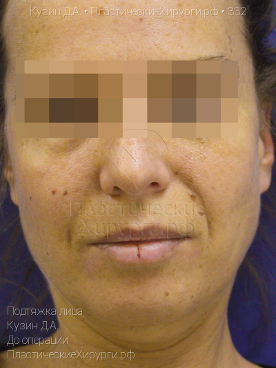 подтяжка лица, пластический хирург Кузин Д. А., результат №332, ракурс 1, фото до операции