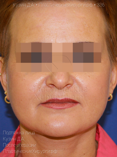 подтяжка лица, пластический хирург Кузин Д. А., результат №336, ракурс 1, фото после операции