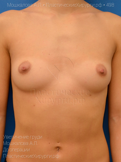 увеличение груди, пластический хирург Мошкалова А. Л., результат №498, ракурс 1, фото до операции