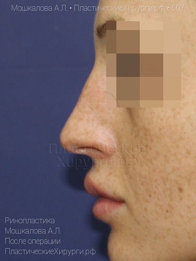 ринопластика, пластический хирург Мошкалова А. Л., результат №507, ракурс 4, фото после операции