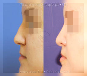 ринопластика, результат №505, предварительное изображение до и после операции