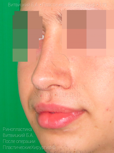 ринопластика, пластический хирург Витвицкий Б. А., результат №179, ракурс 4, фото после операции