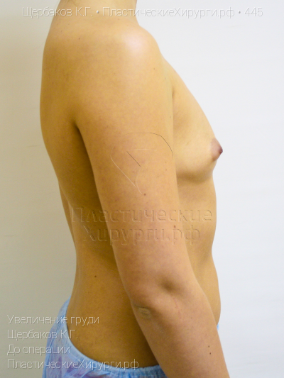 увеличение груди, пластический хирург Щербаков К. Г., результат №445, ракурс 3, фото до операции