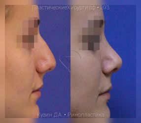 ринопластика, результат №393, предварительное изображение до и после операции