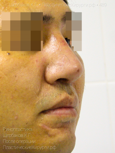ринопластика, пластический хирург Щербаков К. Г., результат №489, ракурс 2, фото после операции