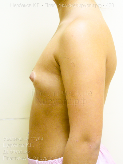 увеличение груди, пластический хирург Щербаков К. Г., результат №430, ракурс 5, фото до операции