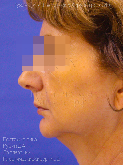 подтяжка лица, пластический хирург Кузин Д. А., результат №340, ракурс 3, фото до операции